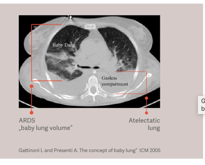 Typische ARDS-Lunge